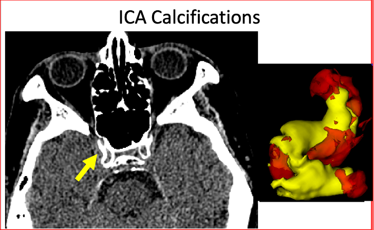 Example of intracranial internal carotid artery (ICA) calcifications as visualized on axial non-contrast computed tomography (CT) scan of the brain (yellow arrow on the left).